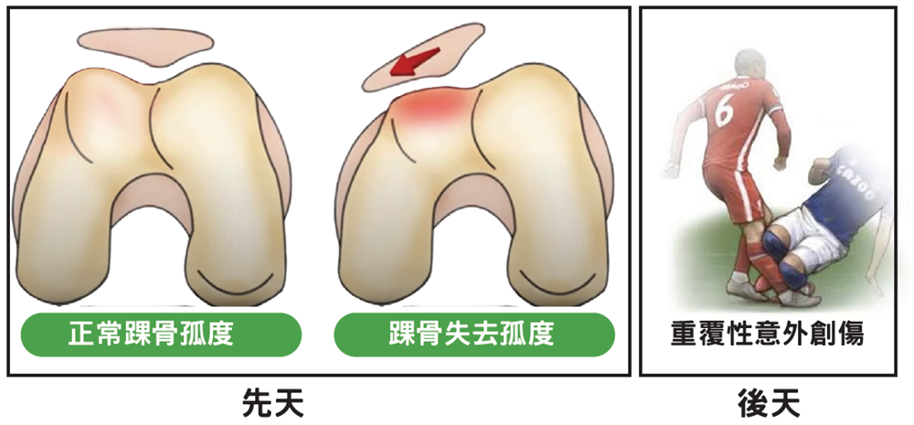 髕骨外移